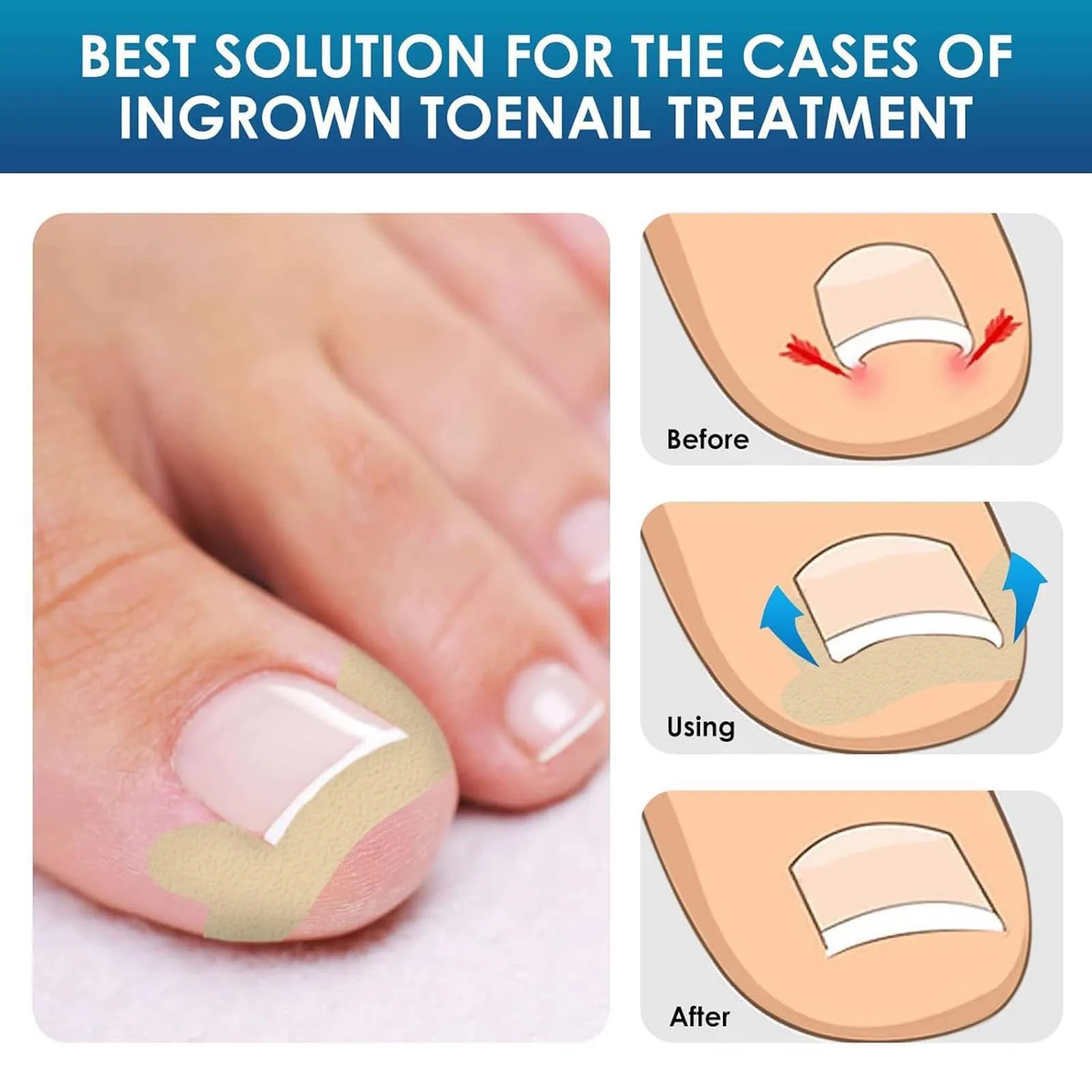 60pcs/box Toe Nail Treatment Patches Breathable Nail Correction Stickers Ingrown Toenail Care Paronychia Painless Repair Patches