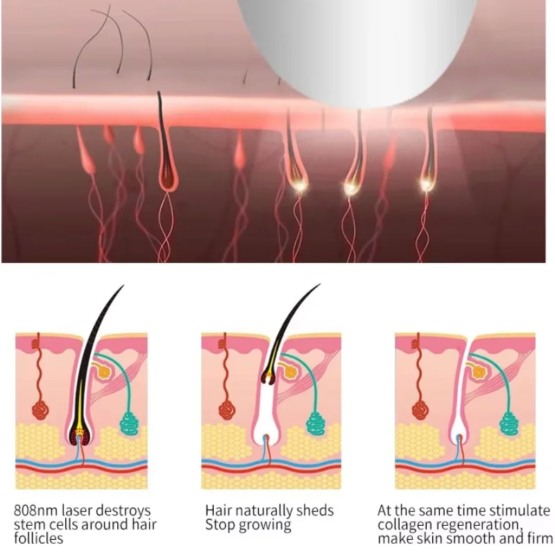 

Аппарат для лазерной эпиляции диодным лазером 3500 Вт, 808 нм, для постоянного безболезненного удаления волос на теле и в подмышках