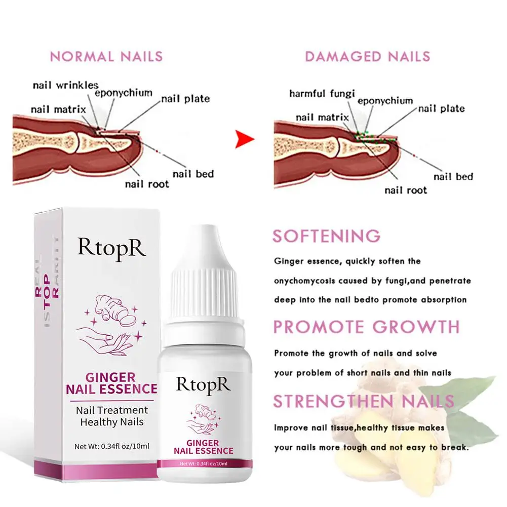 Rtopr الزنجبيل العناية بالأظافر السائل إصلاح الأظافر جوهر العلاج فطريات الأظافر علاج إصلاح فطريات الأظافر الحل 10 مللي #5