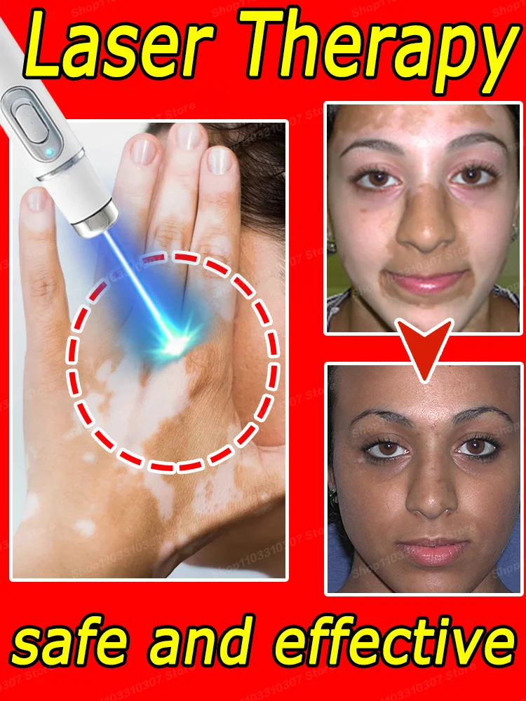 

Blu-ray Pen Vitiligo Improves Quickly White Spots