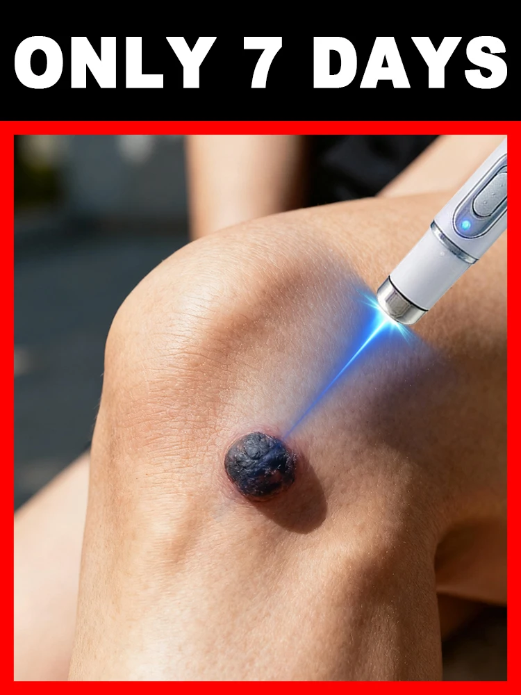 

ᴳᵉⁿᵗˡᵉ ˡᵃˢᵉʳ ᵖᵉⁿ ᶠᵒʳ ʷᵃʳᵗ ʳᵉᵐᵒᵛᵃˡ⸴painless and non-irritating, safe to use