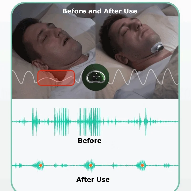 อุปกรณ์อัจฉริยะป้องกันอาการนอนกรนสำหรับผู้ใหญ่ช่วยในการนอนหลับช่วยในการวิเคราะห์ข้อมูลการนอนหลับและการกรนได้หยุดการนอนกรนแบบไร้สาย