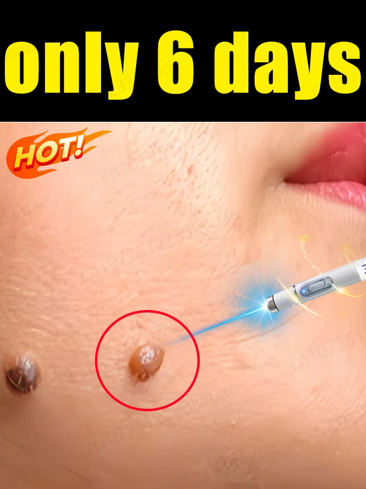 

Blue Light Wart Removal Tool, the Best Skin Tool of 2025