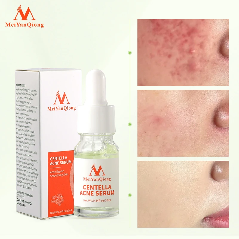 Centella Asiatica Acne Removing Essence Moisturizing Face Serum Shrink Pore Control Oil Liquid  Anti Wrinkle Whiten Skin Beauty