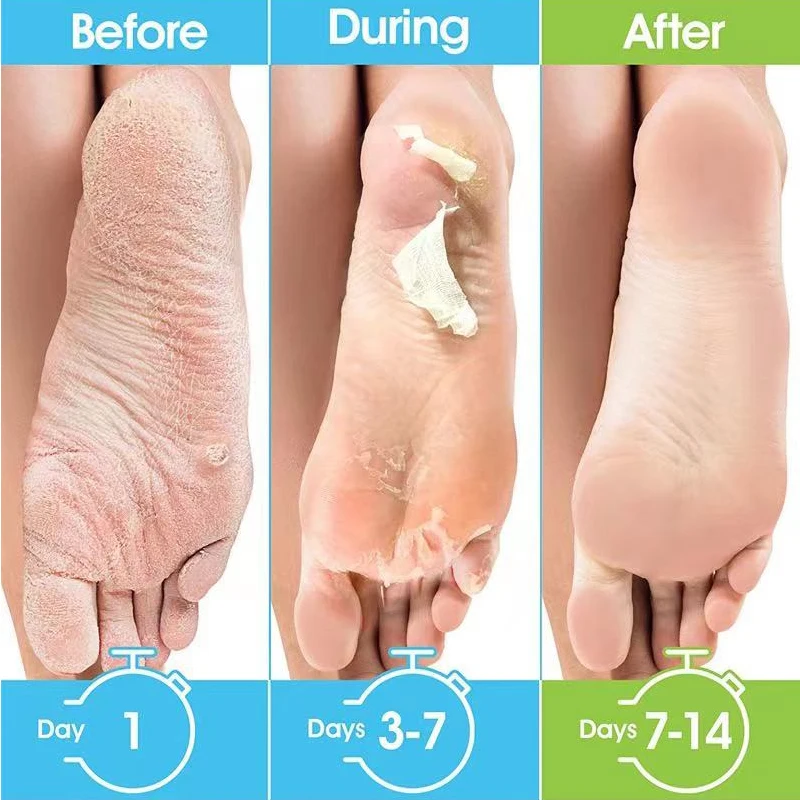 1 Pag=1 Pair Honey Foot Mask for Remove Dead Skin Calluses Exfoliating Foot Mask Feet Cream Whitening Foot Spa Skin Care Tool