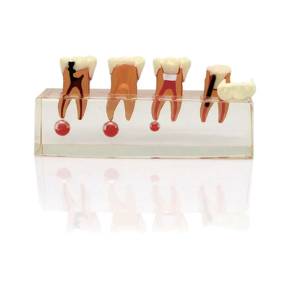 

Dental Teeth Model Endodontic Treatment 4-Stages Clear Acrylic Base Teaching Studying Demo For Dentist M4018