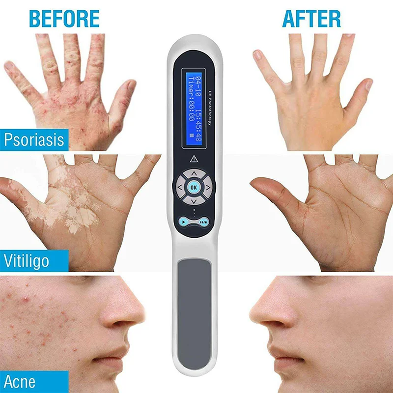 Portable Effective To Treat vitiligo Psoriasis Eczema Uvb Lamps Uv Phototherapy Handheld Led Light Therapy