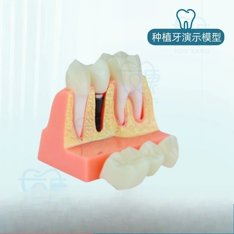 Dental Implant 4x Implant Solution Model, Denture Restoration Dental Implant Interpretation, Removable, Bridge Crown
