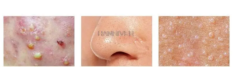 Kit per la rimozione della cellulite con estrattore di comedoni in acciaio inossidabile ultra affilato, pinzette per punti neri, raccoglitrice per acne e set di aghi per sebum