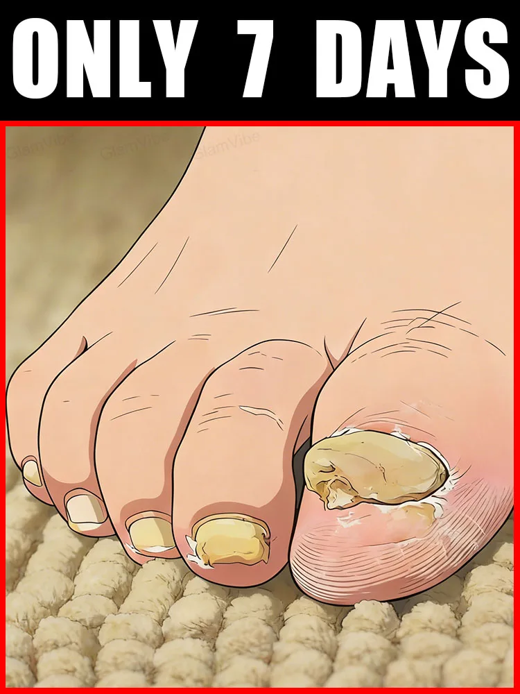 

ᴺᵃⁱˡ ᶠᵘⁿᵍᵘˢ ᵗʳᵉᵃᵗᵐᵉⁿᵗ!Say Goodbye to Yellow Dullness