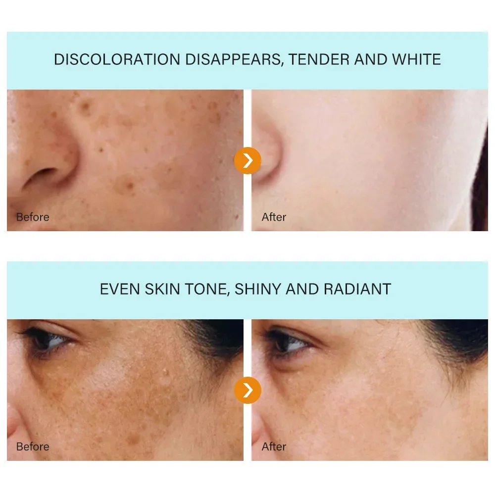 Removedor de manchas escuras para remoção facial, manchas escuras, sardas, melasma, idade, sol