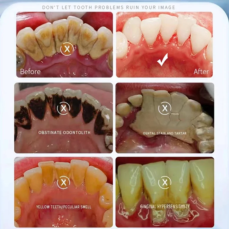 Removedor de cálculo dental, clareamento dos dentes, pasta de dente, limpeza, higiene oral, remoção de halitose, manchas de placa, hálito fresco, novo