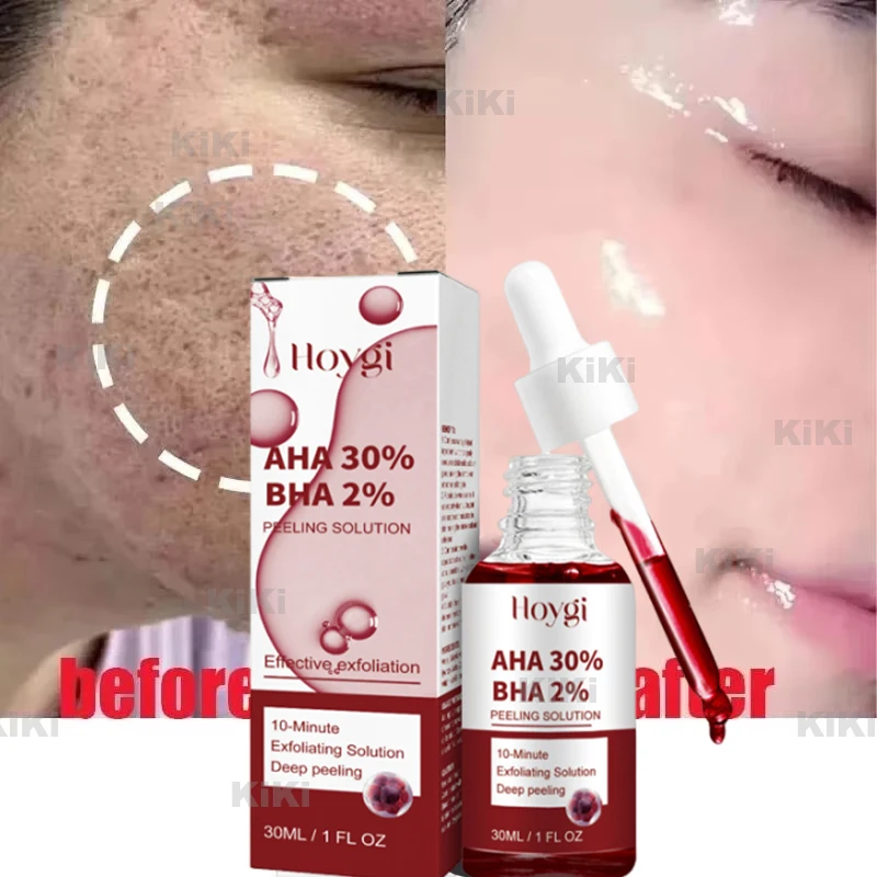 

Acne Removal Serum Salicylic Acid Acne Treatment Repair Spots Scar Moisturizing Oil Control Shrink Pore Face Skin Care Cosmetics