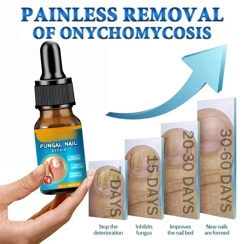 Fungal Nail Removal 10ML Fungal Nail Treatment Oil Foot Repair Essence Toe Nail Fungus Removal Gel Anti Infection Cream