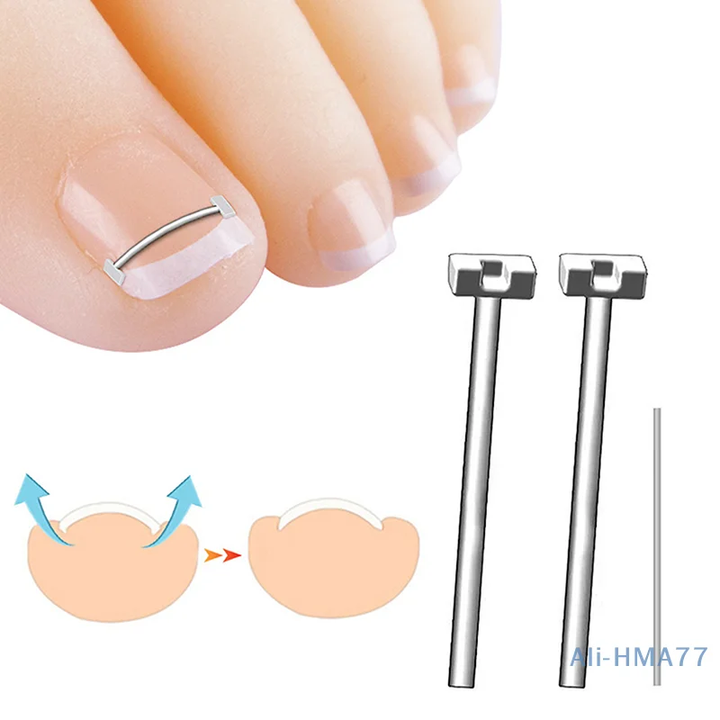 Professional Ingrown Toenail Correction Foot Care Tool Ingrown Toenail Corrector Tools Pedicure Recover Embed Toe Nail Treatment