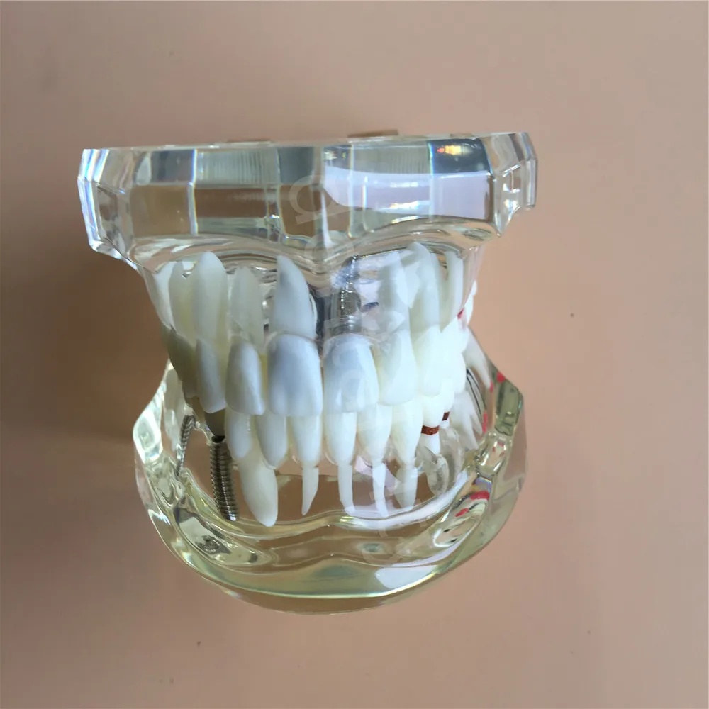 

Dental Implant Disease Teeth Model With Restoration Bridge Tooth Dentist New