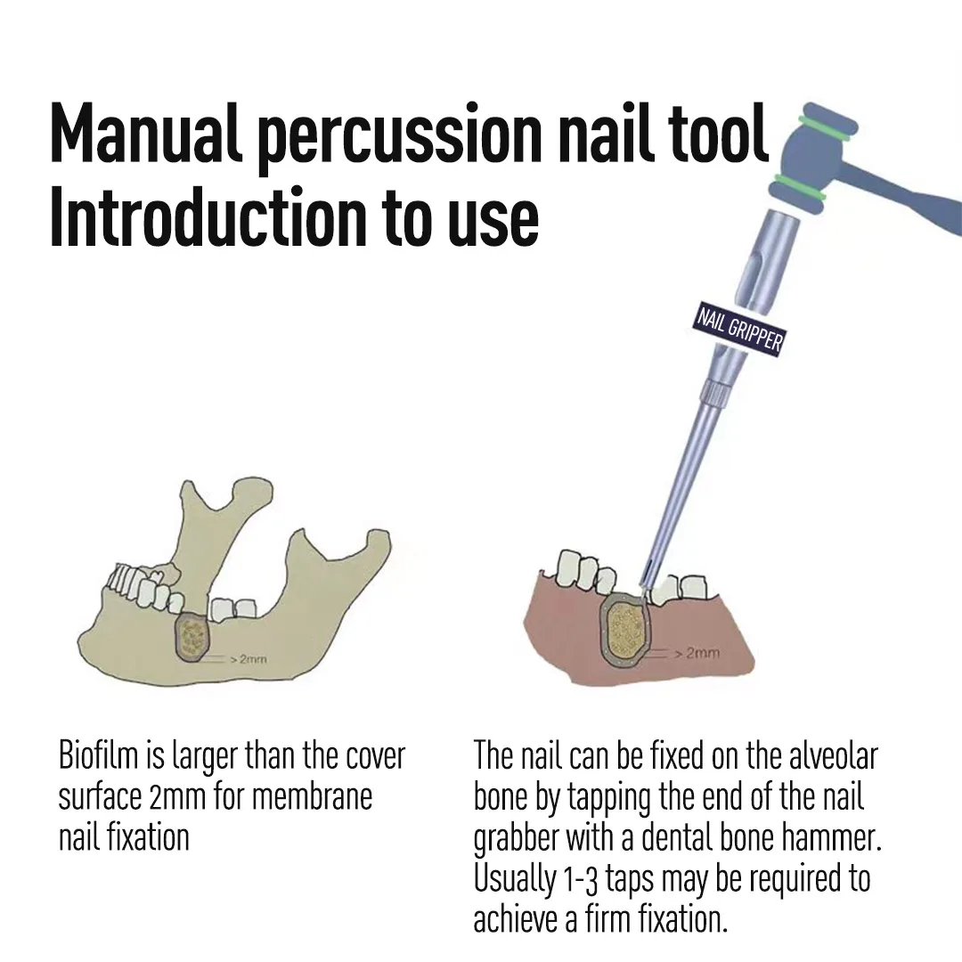 2023 membrana implantu dentystycznego zestaw przyborów do paznokci powiększania kości absorbowalna Biofilm przymocowana do gwóźdź tytanowy skrzynka