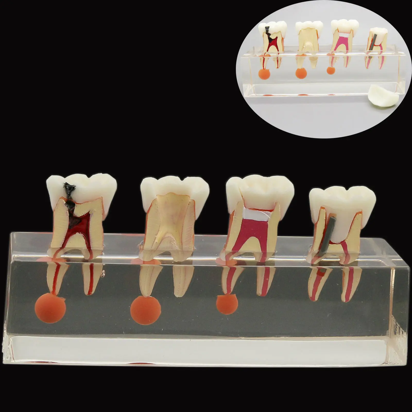 

Dental Teeth Model 4-Stage Endodontic Treatment Clear Demonstrates Model Ortho Implant Adult Standard Typodont Demo