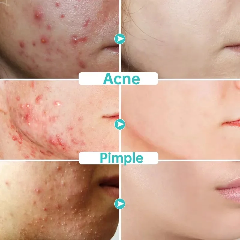 Salicylic Acid Acne Removal Face Cream Acne Treatment Anti Pimples Spots Gel Repair Scars Pores Shrinking Oil Control Skin Care