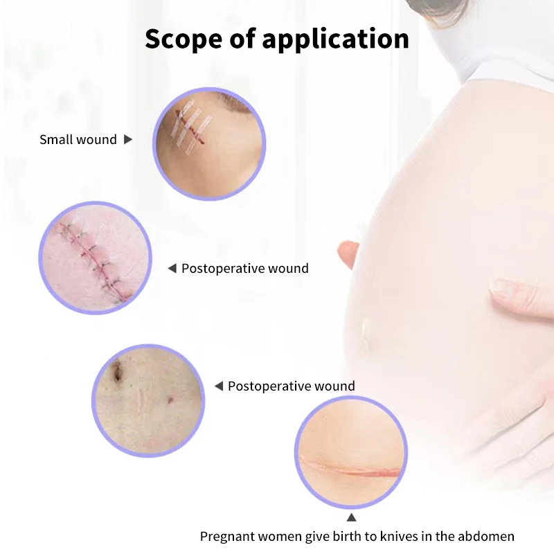 5 Strips Wound Skin Closure Strips Postpartum Wound Repair Cosmetic Surgery Strip Adhesive Medical Suture Free Surgical Tape view 6