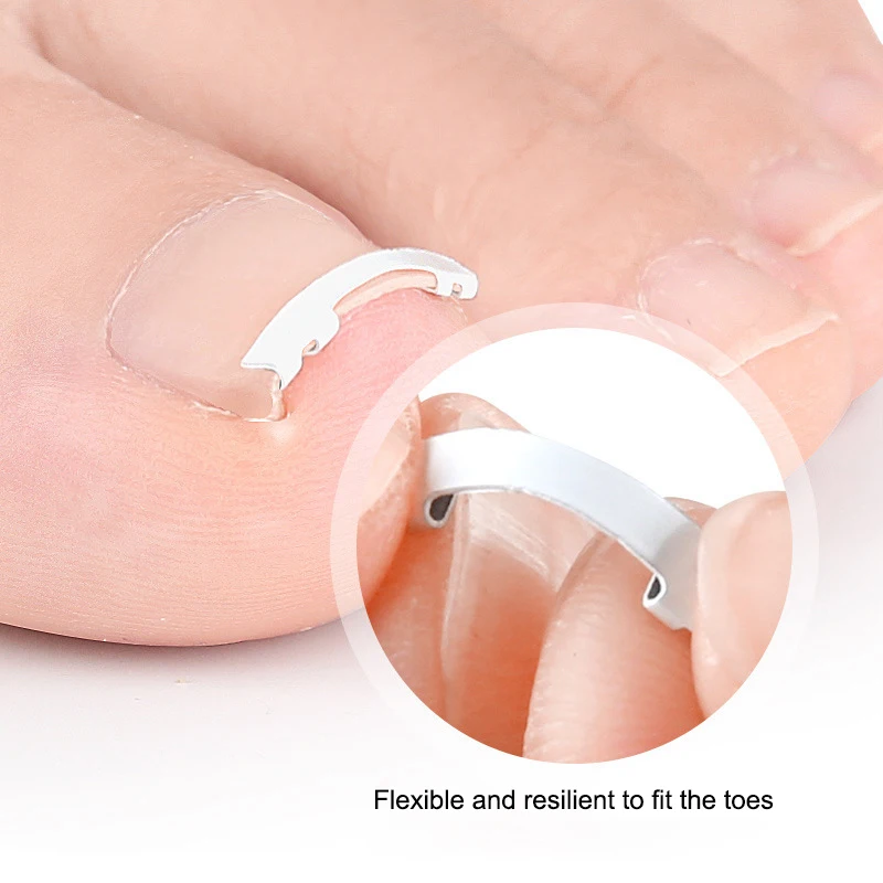 내성발톱 치료용 1개, 내성발톱 교정용 탄력 패치 스티커, 발톱 교정 클립, 발 관리 도구