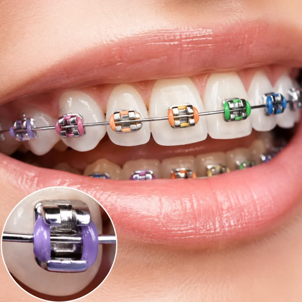 Mehrfarbige orthodontische elastische O-Ring-Gummibänder, mehrfarbige zahnärztliche Ligatur-Gummibänder, orthodontisches Ligaturring-Set - O-Ring-Zahnligaturringe für orthodontische Behandlung und Zahnspangen, 48 Farbe – Detail 12
