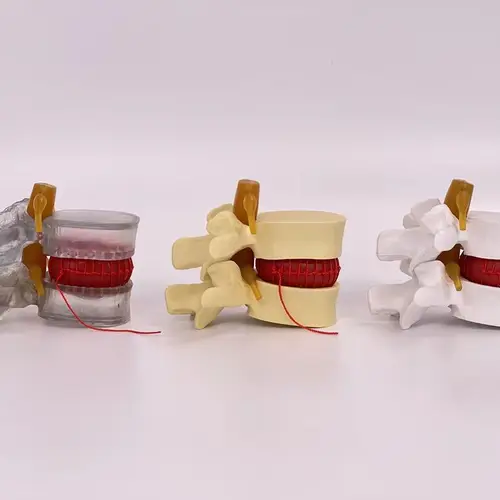 Modelo de patología de columna humana agrandada y columna lumbar, modelo de demostración de hernia de disco lumbar