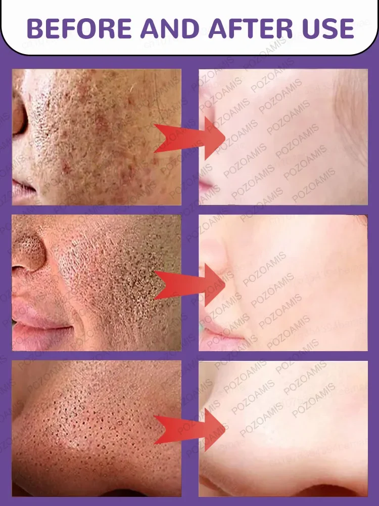 Get rid of large pores