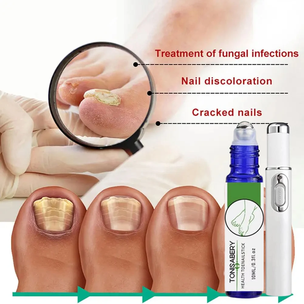 

Nail Fungus Laser Pen Nail Fungus Cleaning Laser Device Nail Fungus Laser Treatment for Damaged Discolored Thick Toenails