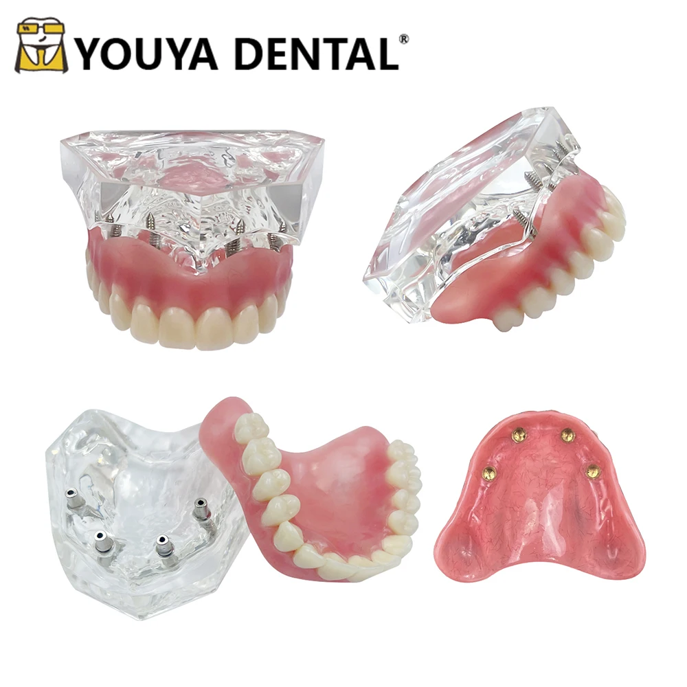 

Dental Upper Jaw Overdenture Teeth Model Removable Implant Practice Model for Dental Technician Studying Teaching