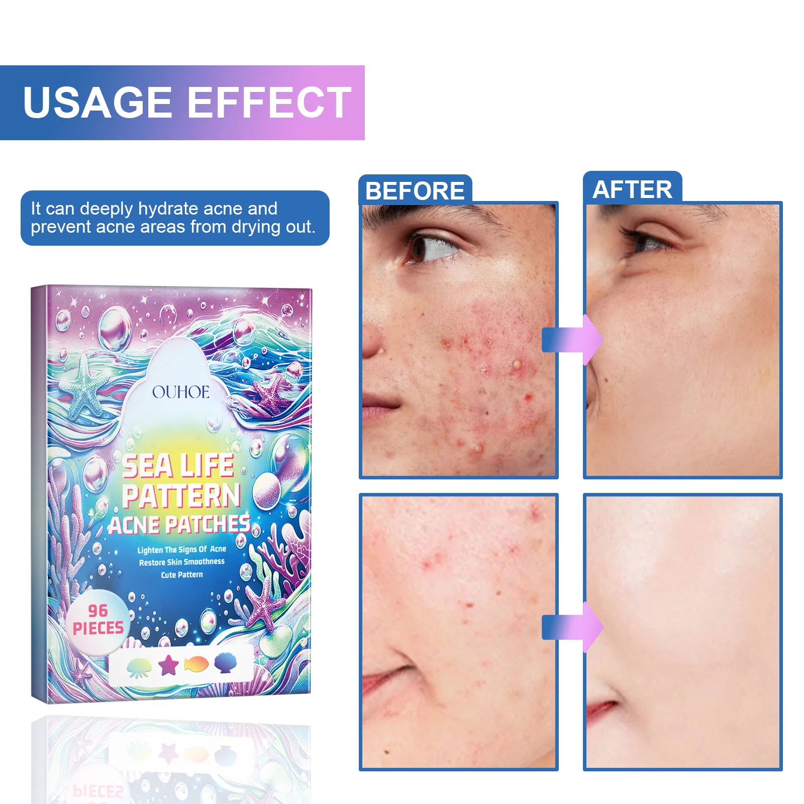 OUHOE Cute Color Acne Patch Lighten Pimples Makeup Concealer Breathable Cute Color Acne Patch