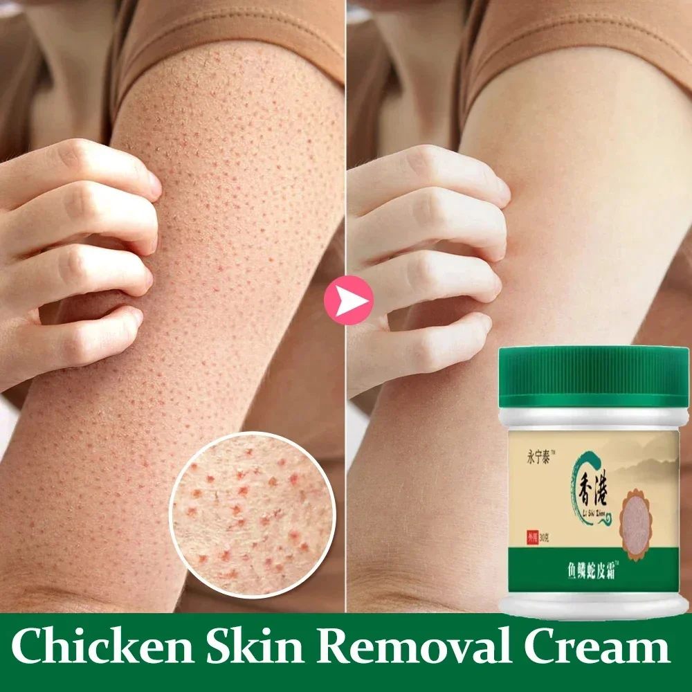 Chicken Skin Removal Treatment Body Cream Repair Keratosis Pilaris Rough Bumpy Pore Spots Moisturizing Whitening Dull Skin Care