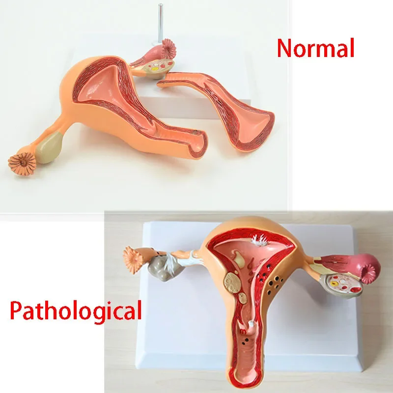 Medical Science Normal/Pathological Uterus Ovary Anatomical Model Anatomy Cross Section Medical teaching supplies