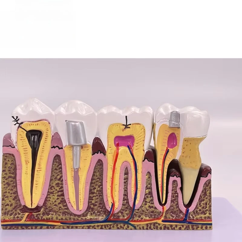 Human Dental Model Teeth Model Pathology Teaching Model