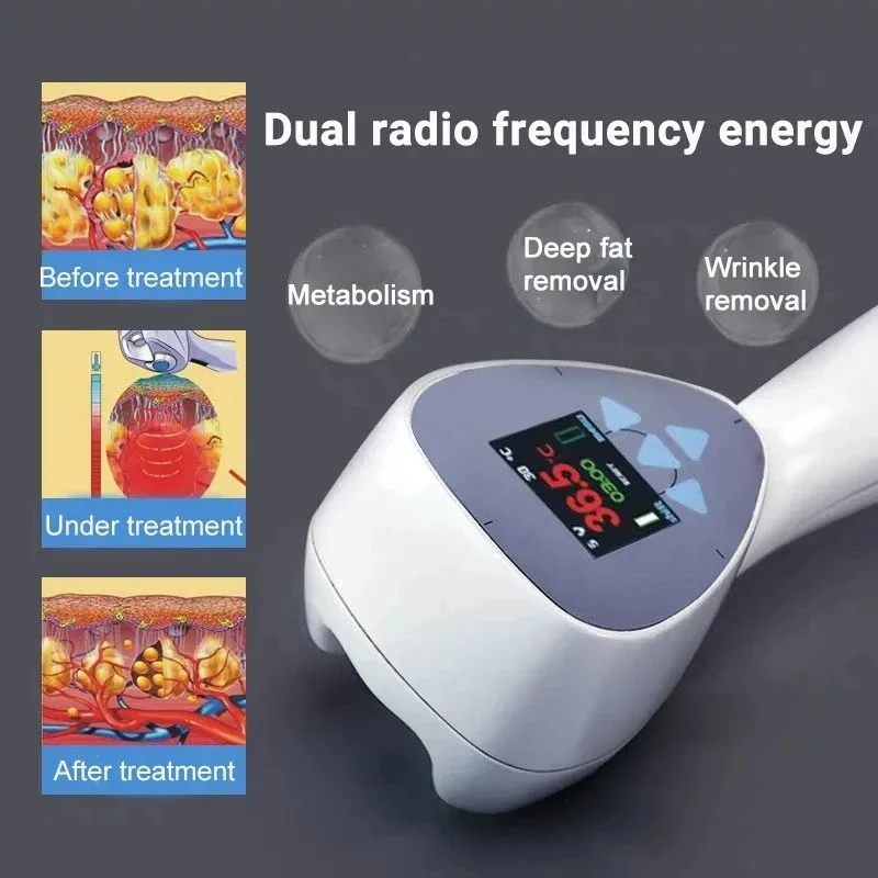 أحدث الترا 360 الدهون الموقد الدهون مزيل الوجه رفع الجلد تشديد التخسيس الجسم الكنتوري السيلوليت المهنية