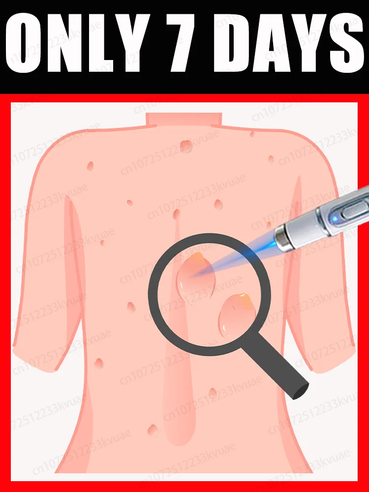 

blue light pen solve warts, hot sale wart care tools