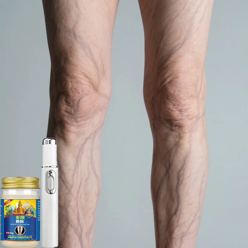 

Лазерная ручка «Паук и варикозное расширение вен» | Неинвазивная терапия вен на ногах для видимого уменьшения и поддержки кровообращения