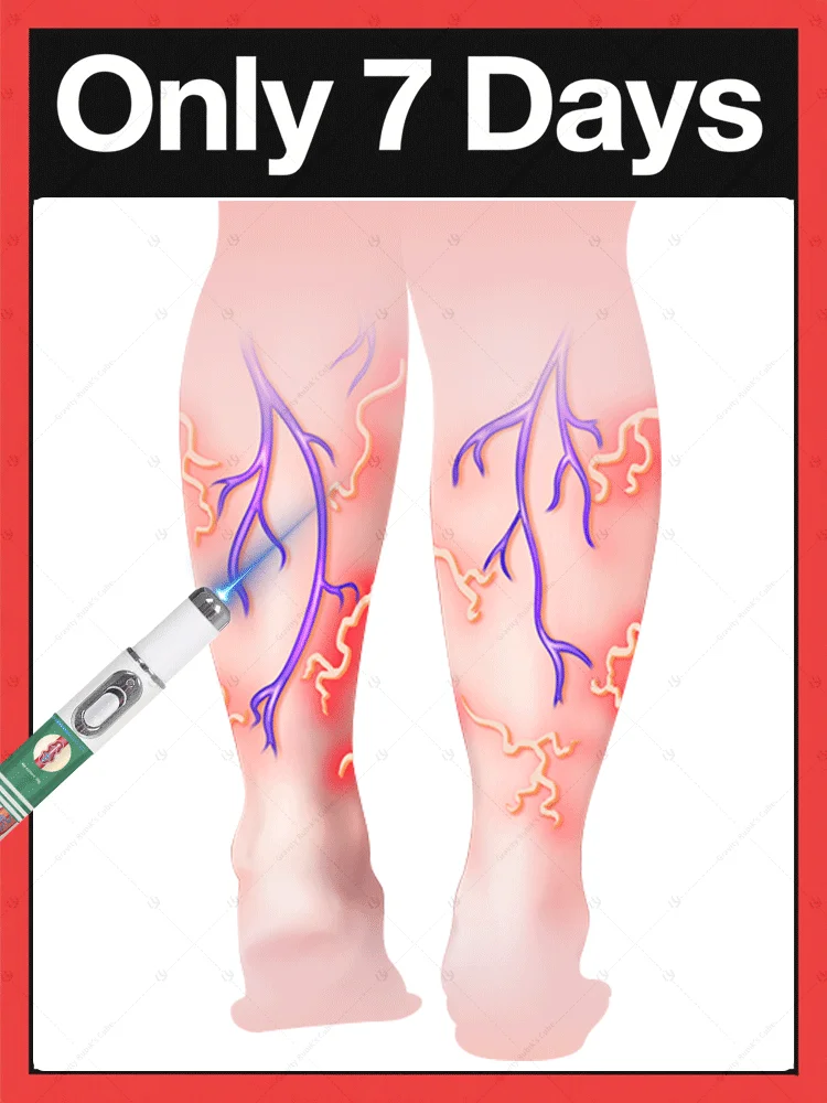 

Laser vein | veins hand exercise | cream varicose veins