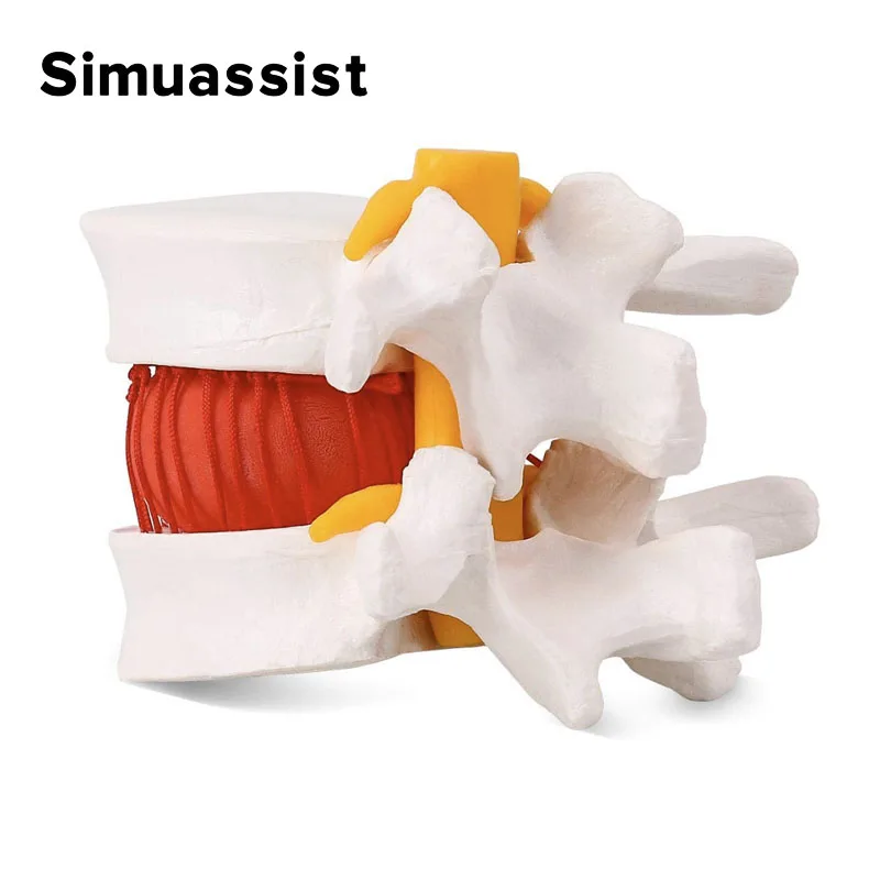 Anatomical Spine Lumbar Disc Herniation Model Medical props model Anatomy Medical Teaching Tool