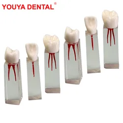 6pcs Restoration Dental Training Model Endodontics Root Canal Block Resin Endo Teeth Model For Studying Practice Pulp Cavity RCT