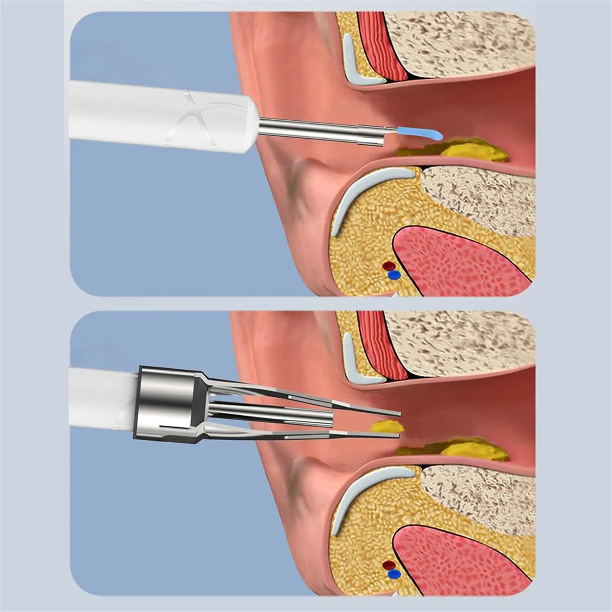 popop HD Visual Ear Cleaner with Camera with Tweezers Wireless Otoscope Ear Pick for Pick Remove Ear Dirt Health Care B