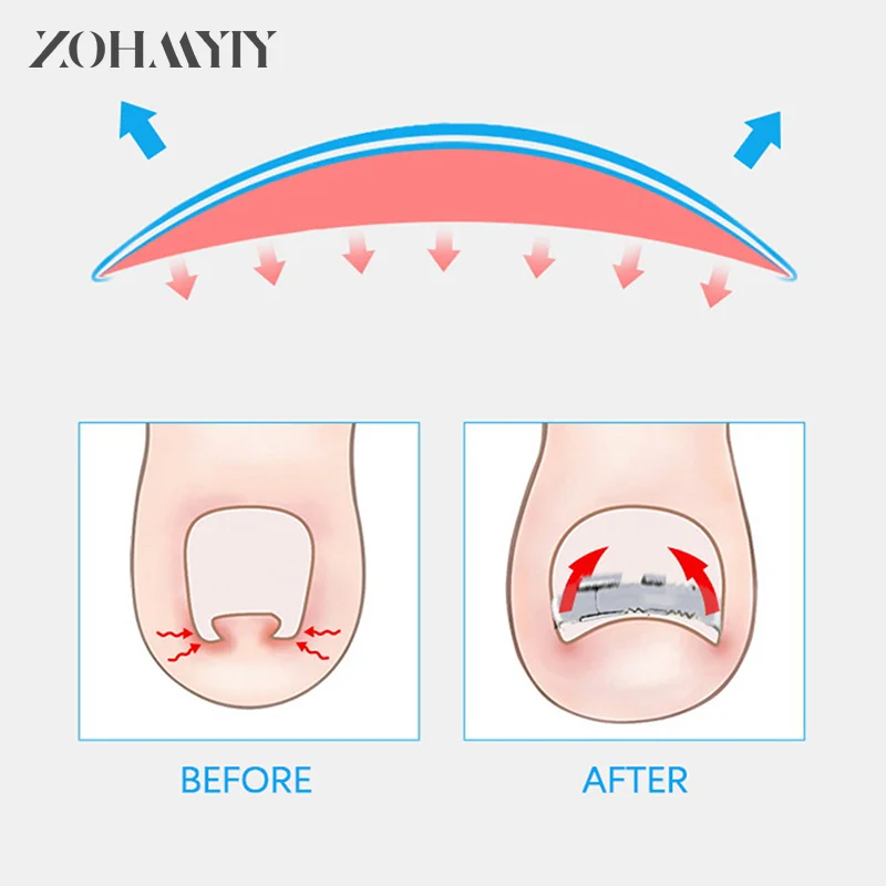 Przyrządy do korektora paznokci z wrośniętymi palcami Pedicure odzyskują terapia na paznokcie z wrośniętymi narzędzie do pielęgnacji stóp korekcji paznokci