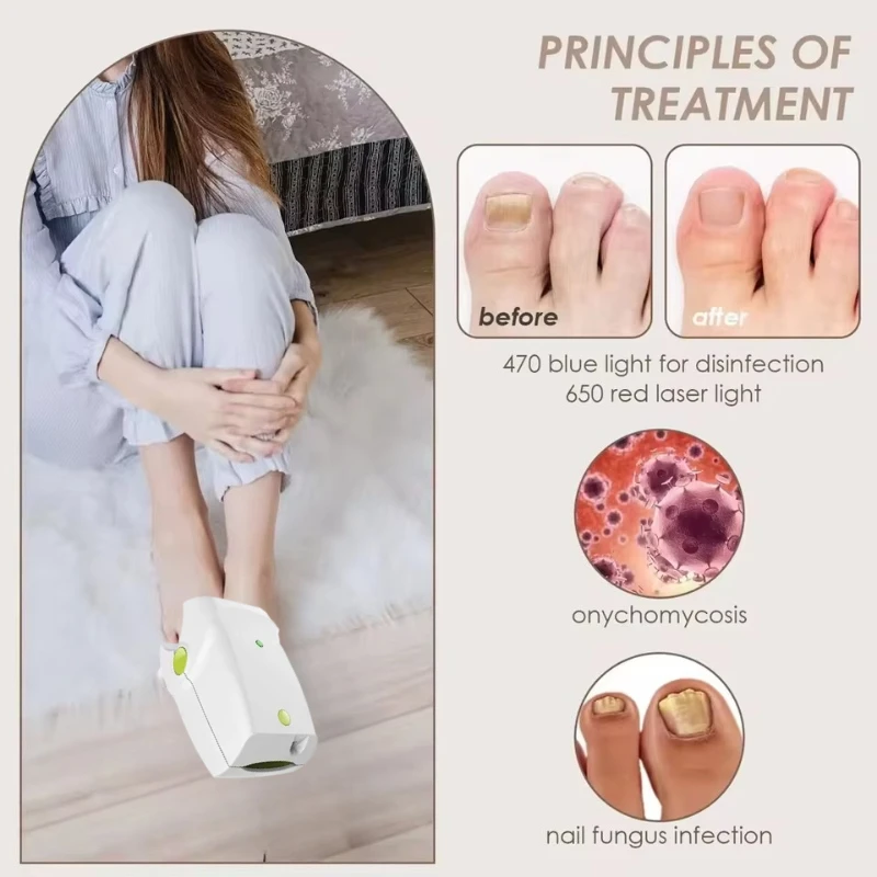 

2025 Home Use Cure Toe Nail Fungus Blue Light and Laser Light Therapy Device Onychomycosis Antifungal LLLT Physiotherapy