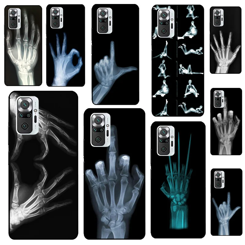 X-Ray Hand Bones Ca… - image