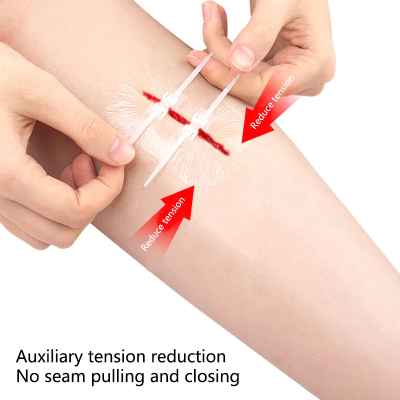 Fermeture de plaie d'urgence, point zippé, sutures, bandaids, réparation de blessures sans points, activités de plein air, plaie à caillot rapide