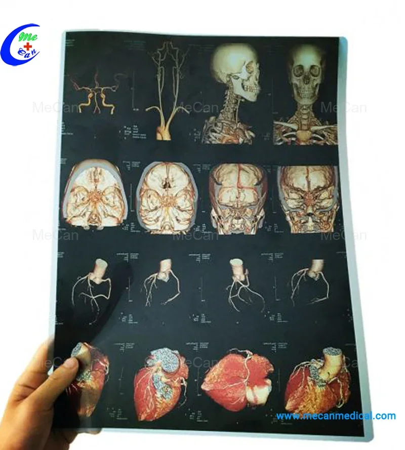 Radiology medical dry inkjet X-ray film for hospital film printers