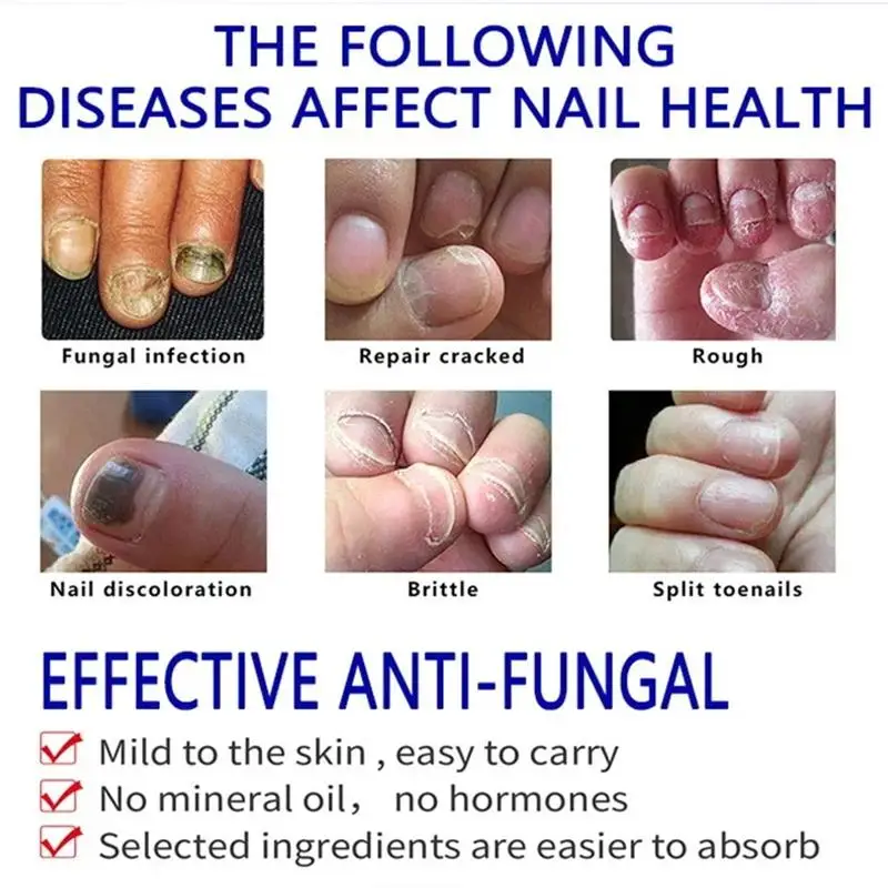 7 giorni Trattamento Fungo Delle Unghie Siero Riparazione Unghie Dei Piedi Rimozione Fungine Essenza Anti Infezione Paronichia Onicomicosi Assistenza Sanitaria