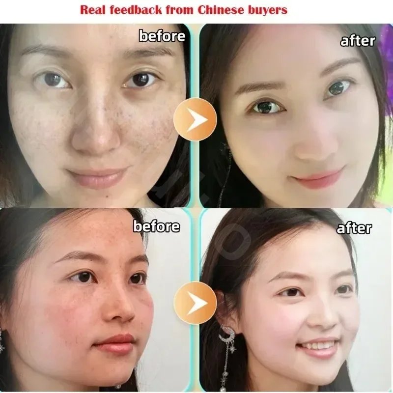 Original Whitening Freckle Face Cream Moisturizing Remove Freckles Age Spots Melasma Pigment Melanin Acne Spot Skin Care