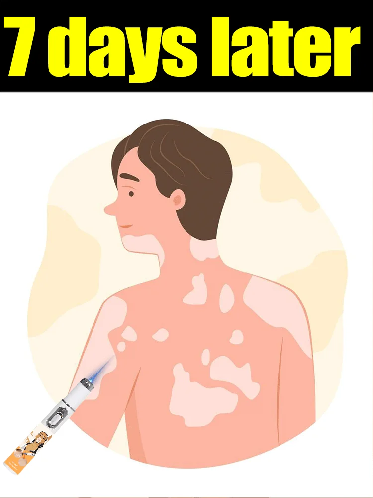 2025 New Laser Says Goodbye To Vitiligo
