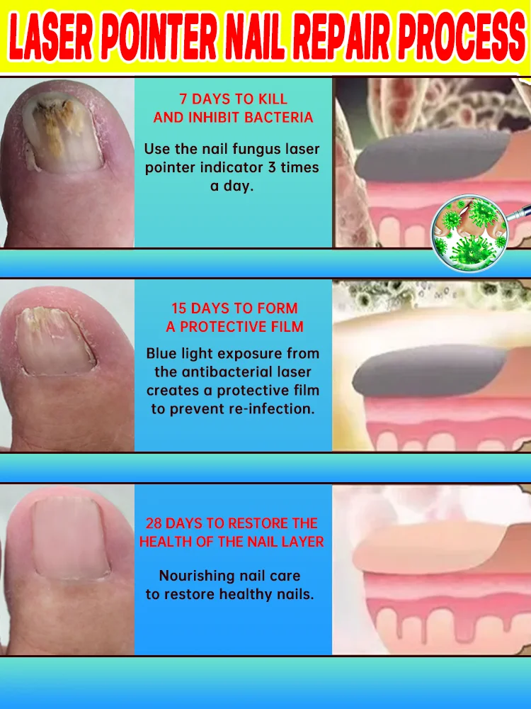 爪甲修復レーザーポインター、カビ爪が消え、爪が美しく透明に。抗菌・抗炎症効果も抜群。